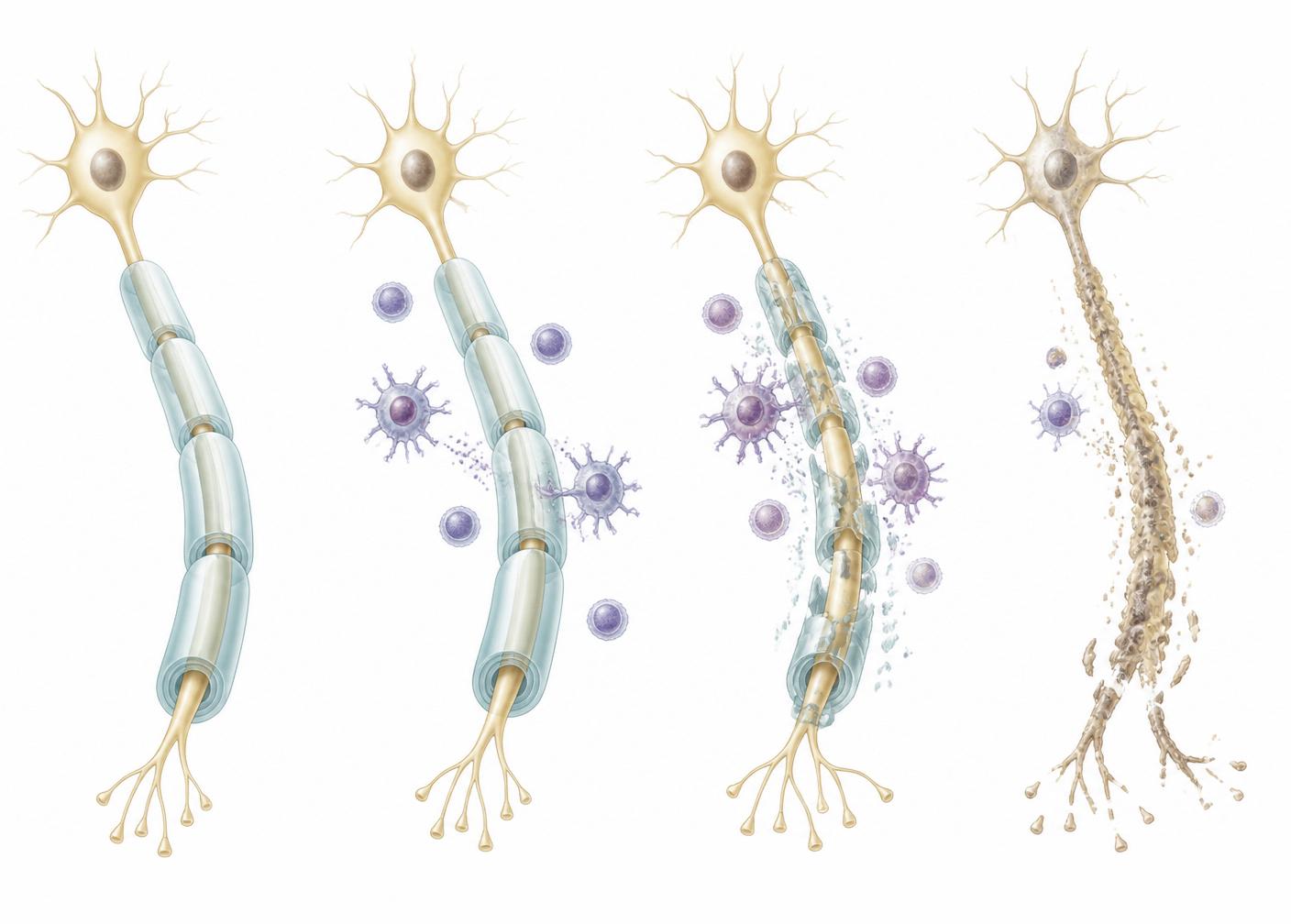 Illustration of myelin, immune activation, demyelination, and axonal injury in Multiple Sclerosis