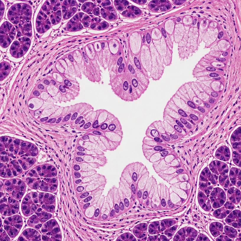 Histology of a pancreatic intraepithelial neoplasia precursor lesion