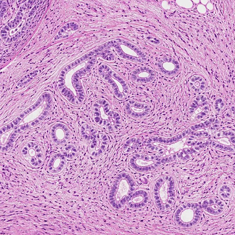 Histology of localized pancreatic ductal adenocarcinoma within desmoplastic stroma