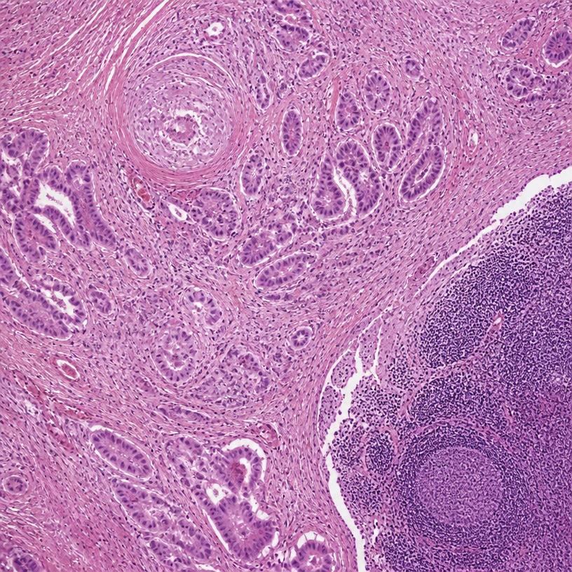 Histology showing pancreatic tumor invasion adjacent to a lymph node