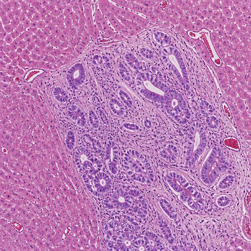 Histology of a metastatic pancreatic adenocarcinoma deposit in liver tissue