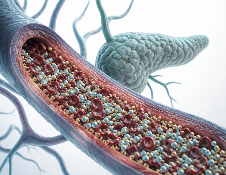 Illustration of a blood vessel crowded with glucose alongside a diminished pancreas